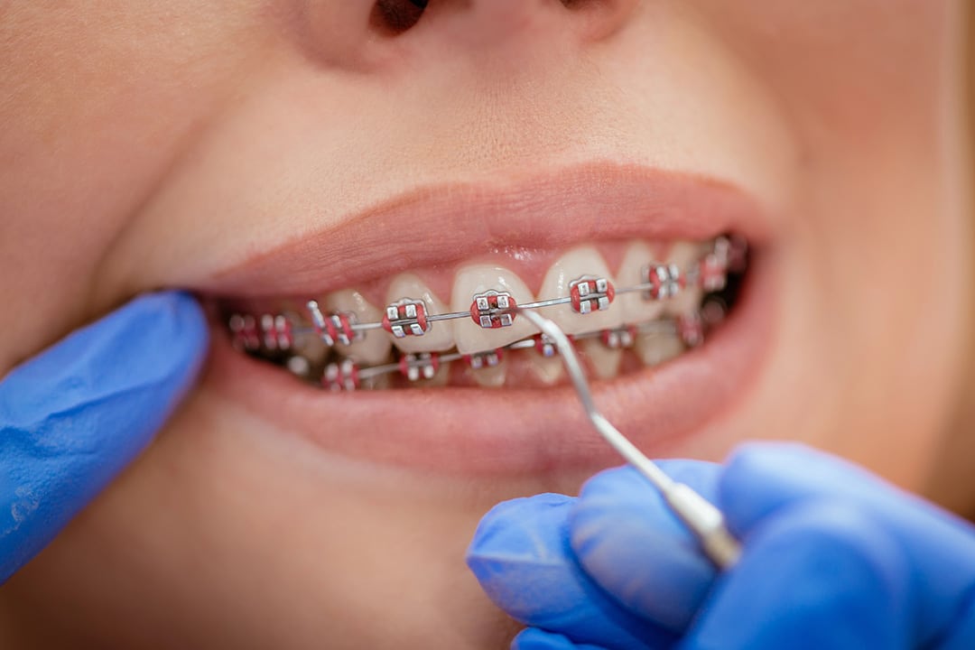 Child wearing braces at the dentist