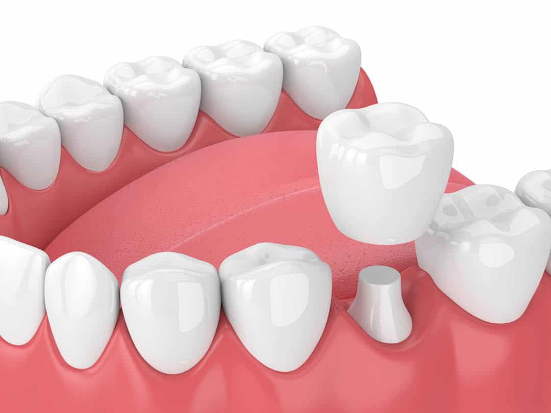 An illustration of a dental crown. A porcelain tooth fused on top of an existing tooth.
