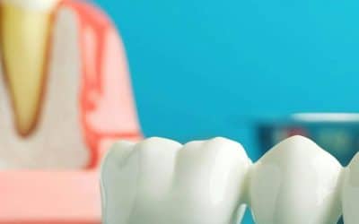 What is a Dental Crown and Bridge? A Comprehensive Guide