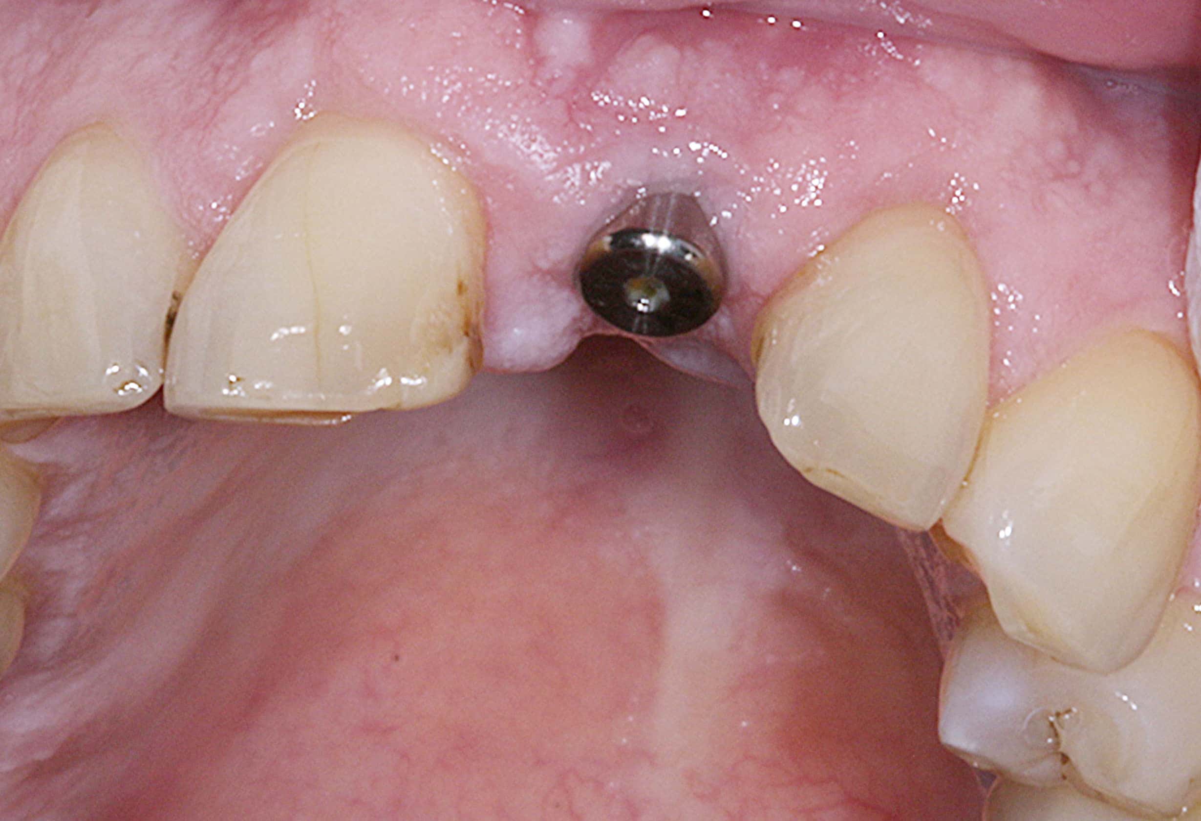 A dental implant