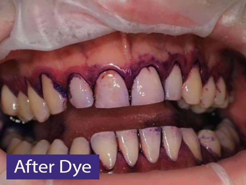 disclosed biofilm with dye treatment
