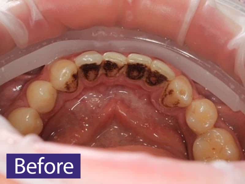 minimally invasive GBT treatment before