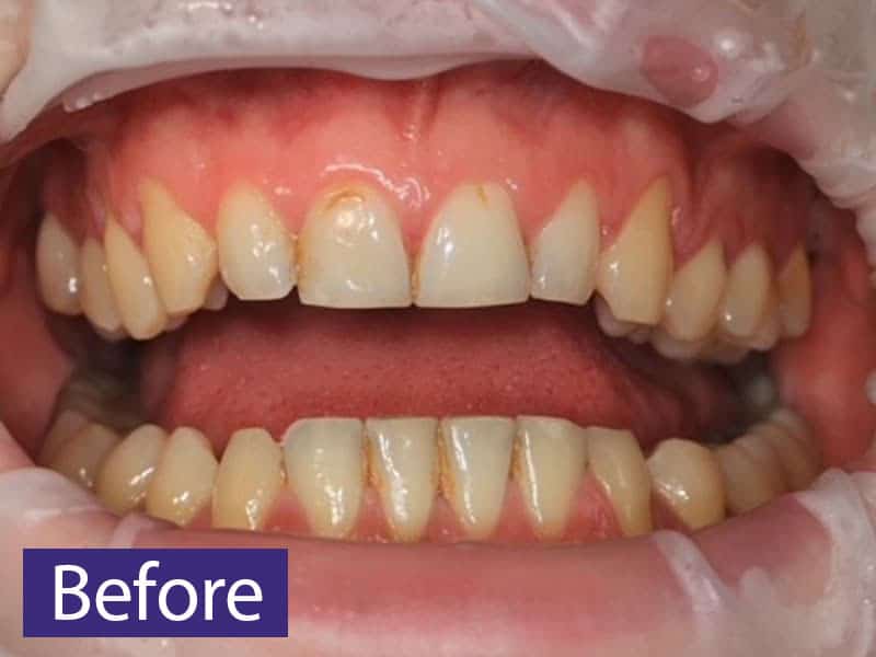 optrigrate being used for GBT