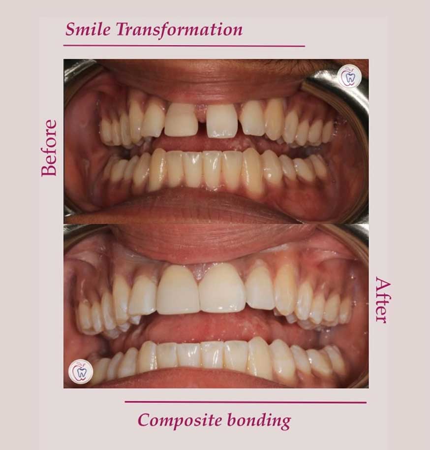 Composite bonding before and after images of teeth Composite bonding before and after images of teeth