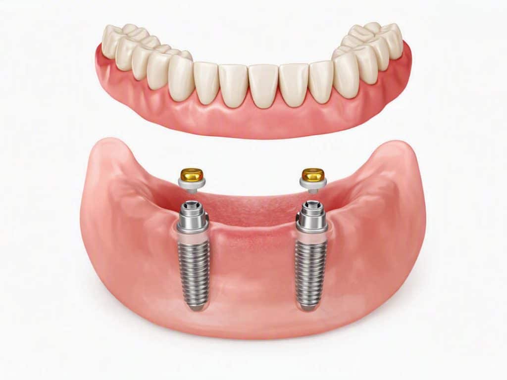 3D illustration showing lower jaw with two dental implants and a removable overdenture positioned above.